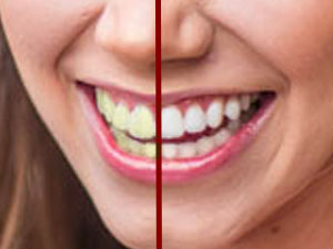 How to Whiten Teeth in a Photo