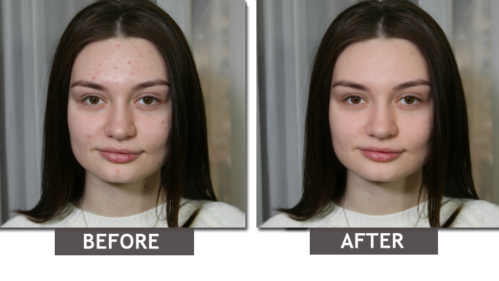 Remove blemishes from photo and see the result